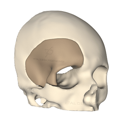 Vista isométrica derecha de paciente con implante personalizado de PEEK en 3D de zona orbital y pterional.