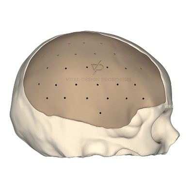 Vista lateral derecha de paciente que lo sometieron a una craniectomía descompresiva por TCE severo. Para la reconstrucción se le realizó craneoplastia con implante PEEK a la medida.