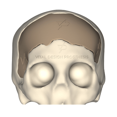 Vista frontal de paciente que sufrió TCE Severo, le tuvieron que realizar craniectomía descompresiva frontal bilateral y posteriormente le realizaron craneoplastia personalizada con implante PEEK en 3D.