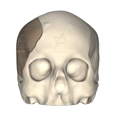 Vista frontal de paciente con implante personalizado de cráneo de lado derecho de gran tamaño.