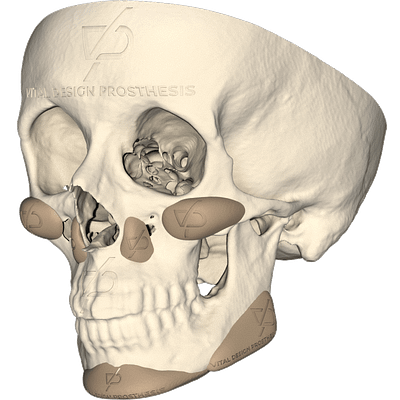 aumento_facial_peek