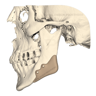 Vista lateral izquierda de paciente con síndrome de mandíbula prominente hacia abajo, con evidente falta en ángulo mandibular, se coloca implante de ángulos mandibulares para mayor volumen, contorno y simetría facial.