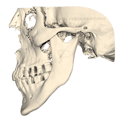 Vista lateral izquierda de paciente con síndrome de mandíbula prominente hacia abajo, con evidente falta en ángulo mandibular.