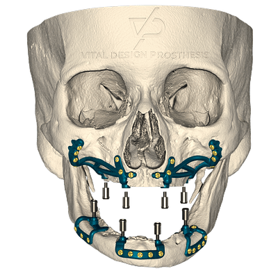 Frontal view of patient with severe maxillary atrophy with 2 customs bimaxillary subperiosteal implants with custom bases for locator.