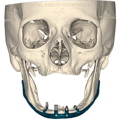 Frontal view of patient with severe bilateral atrophic jaw with subperiosteal implant made of titanium grade 23 simulating a all on 4 type implant with differents types of attachments in each base.