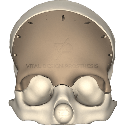 Vista frontal de paciente que le retiraron un tumor cerebral que también dañaba la estructura del hueso. Se le realizó cirugía de reconstrucción con implante frontal personalizado en PEEK.