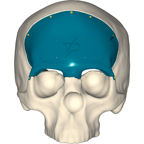 Vista frontal de paciente con meningioma transicional retirado y con cirugía reconstructiva con implante personalizado de titanio.