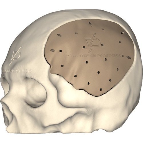 Vista isométrica izquierda de paciente que sufrió un traumatismo cráneo encefálico severo. Para reconstrucción de cráneo se le realizó una craneoplastía personalizada en PEEK.