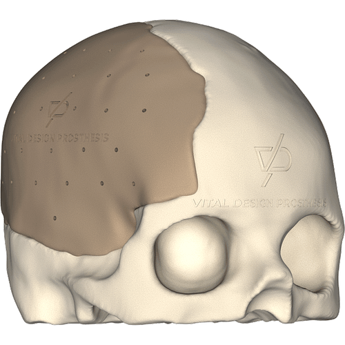 Vista isométrica derecha de paciente que sufrió un TCE severo y que le tuvieron que realizar una craniectomía descompresiva de urgencia. Para la reconstrucción se le realizó craneoplastia con PEEK a la medida.