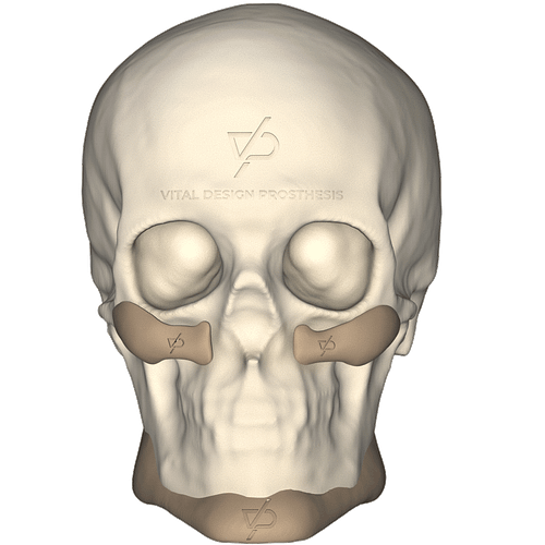 Facial_Augmentation_Implant