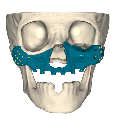 Osteoradionecrosis_Bilateral_Maxillary_implant