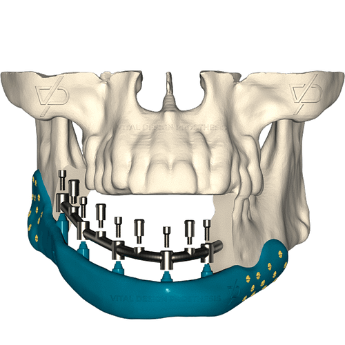 Mandibular_Reconstruction