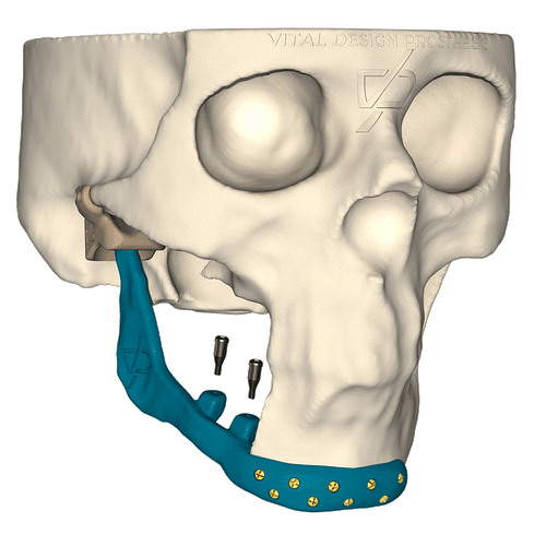 TMJ_Custom_Implant