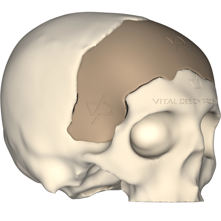 Vista isométrica derecha de paciente que sufrió TCE Severo, le tuvieron que realizar craniectomía descompresiva frontal bilateral y posteriormente le realizaron craneoplastia personalizada con implante PEEK en 3D.