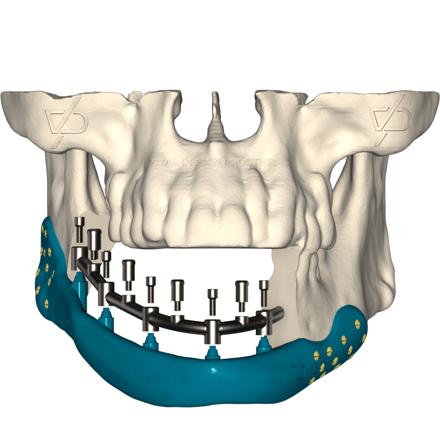 Mandibular_Reconstruction