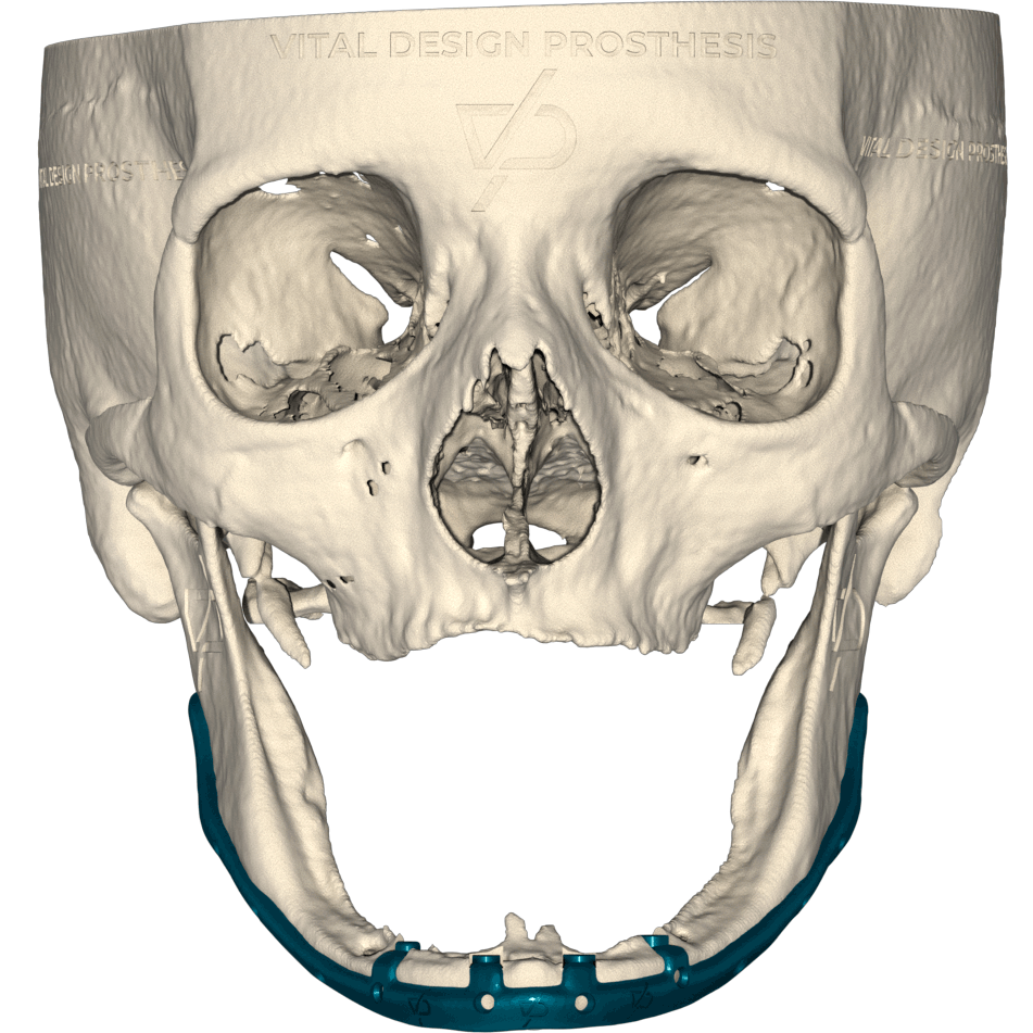 Frontal view of patient with severe bilateral atrophic jaw with subperiosteal implant made of titanium grade 23 simulating a all on 4 type implant with custom bases for dental attachments.