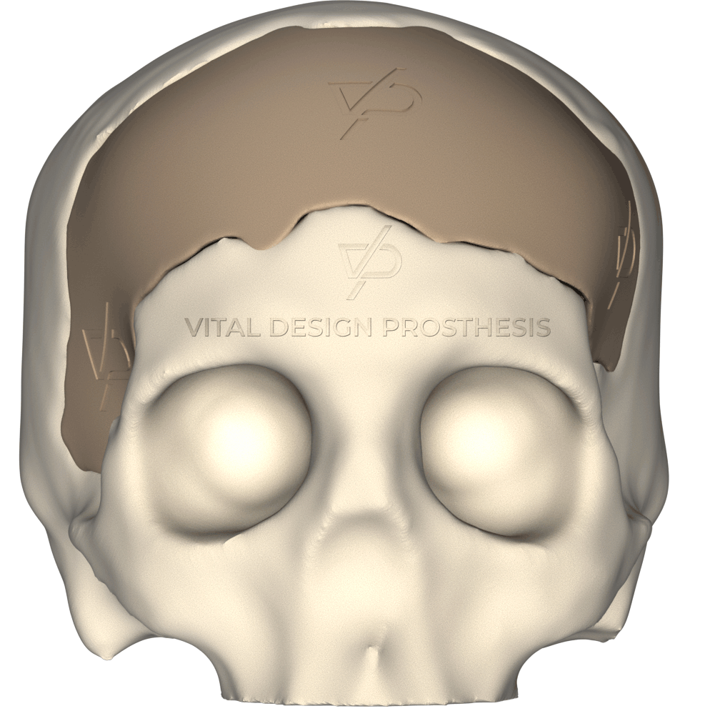 Vista frontal de paciente que sufrió TCE Severo, le tuvieron que realizar craniectomía descompresiva frontal bilateral y posteriormente le realizaron craneoplastia personalizada con implante PEEK en 3D.